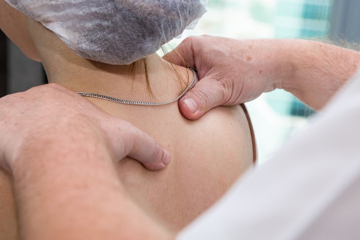 Distal Clavicle Excision